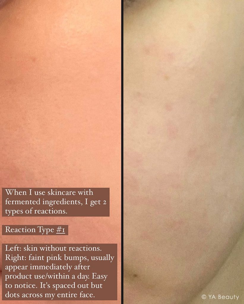 Acne breakouts starting from small pink bumps on face due to allergic reaction to fermented ingredients in skincare and makeup products, before and after.